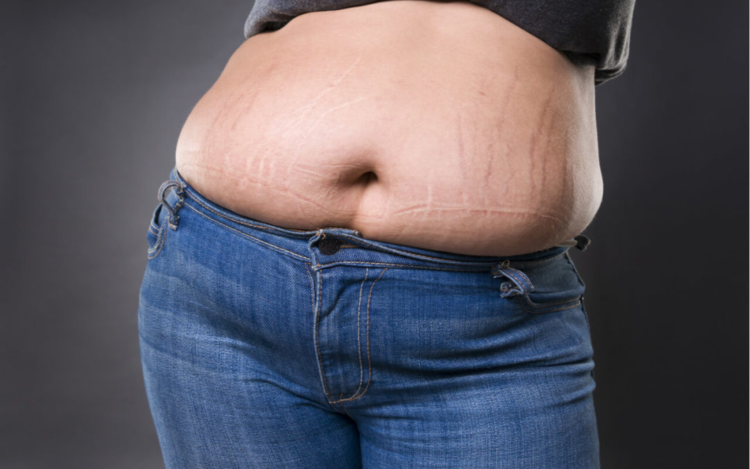 Tummy Tuck For Stretch Marks: Is It Effective? How Does It Work?