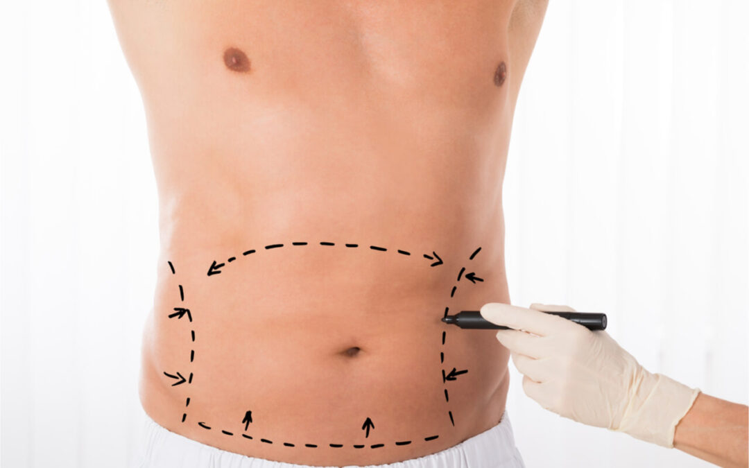 Feel Better Fast: What Are The Best Tummy Tuck Recovery Tips?